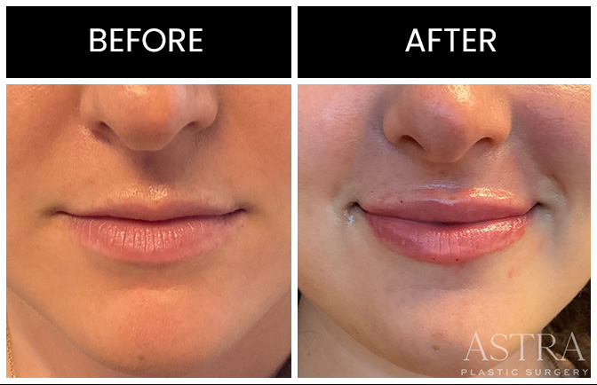 Atlanta Lip Augmentation Results